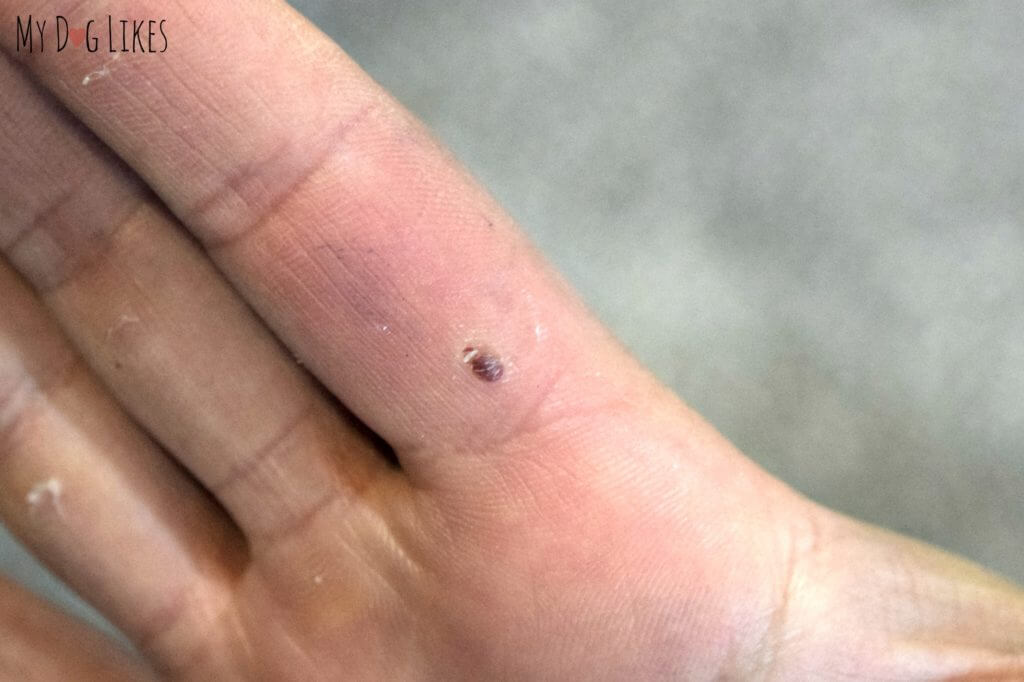 Small blood blister from pinching finger!